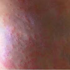 MSP y Ambiente investigan casos de erupciones cutáneas tras baños en el río Uruguay